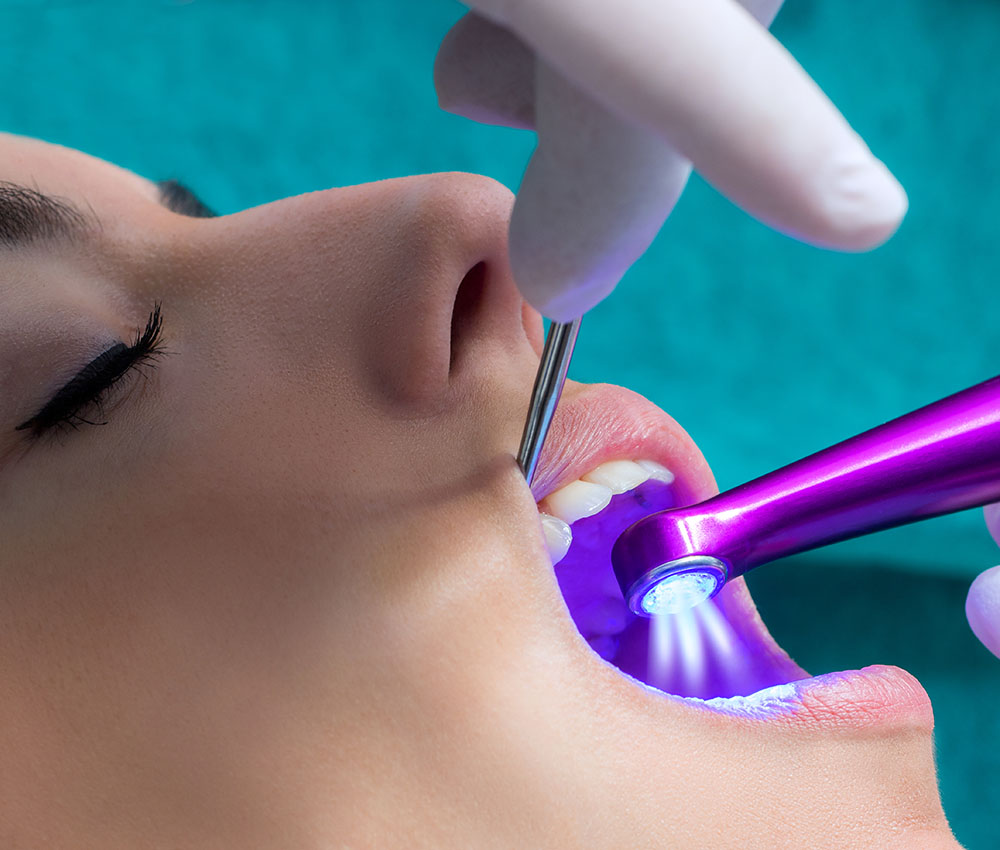 fissure-sealant-service fissure sealant service Adatho Dental Fissure Sealants